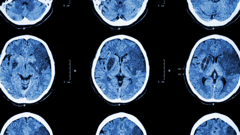 BIAA Raises Awareness of Acquired Brain Injury During Stroke Month