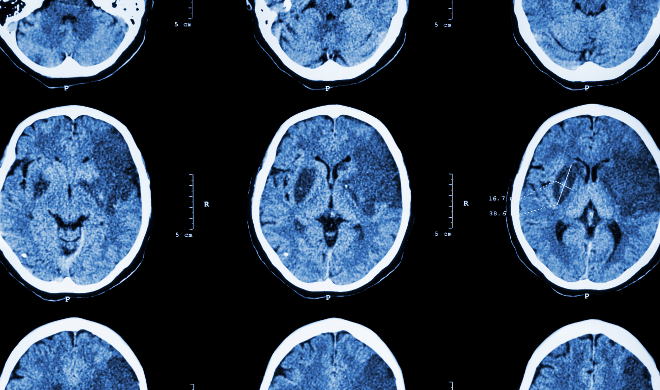 What is the difference between an acquired brain injury and a traumatic brain injury?